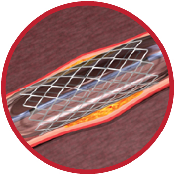 preocedimentos endovasculares