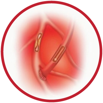revascularização do miocardio